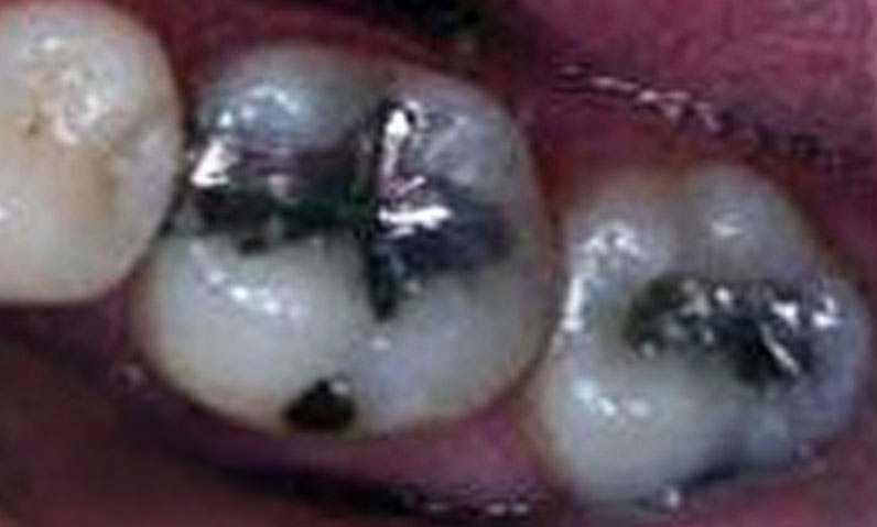 Close-up of dental cavities and fillings in molars, illustrating before treatment condition for smile makeover services at Palani Center for Dental Implants.