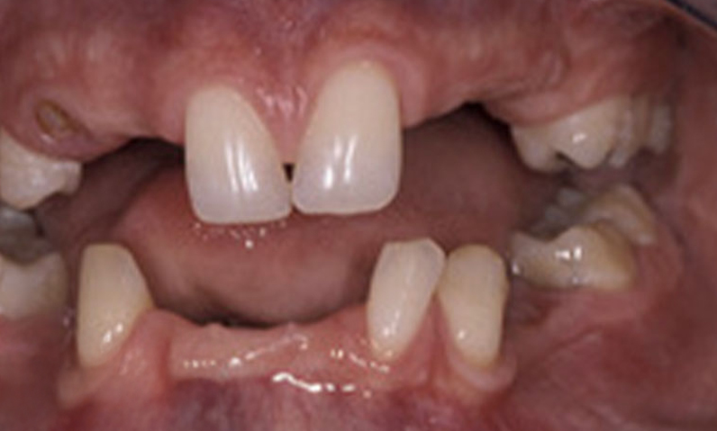 Close-up of a patient's mouth showing uneven and misaligned teeth, highlighting the need for dental treatments like crowns or veneers in smile makeover procedures.