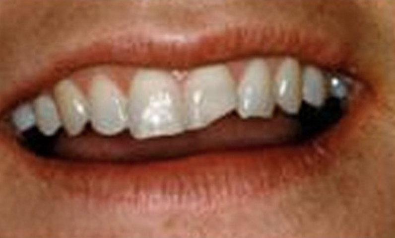 Close-up of a smiling mouth showcasing healthy, white teeth, relevant to smile makeover services offered by Dr. Palani.