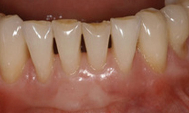 Close-up of natural teeth showing slight discoloration, relevant to dental procedures and smile makeovers at Palani Center For Dental Implants.