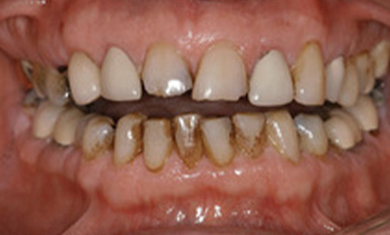 Before image of a patient's teeth showing significant discoloration and plaque buildup, relevant to dental makeover services at Dr. Palani's practice.