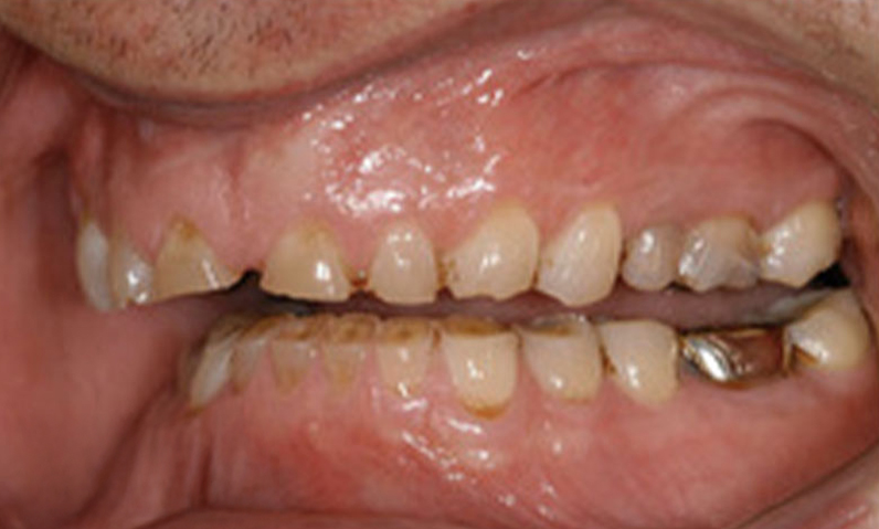 Close-up of a patient's teeth showing dental issues, relevant to pre-operative preparation for smile makeovers and dental treatments at Dr. Palani's office.