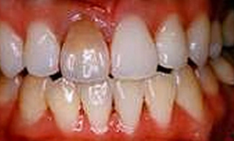 Close-up of teeth showing dental condition, relevant to smile makeover services at Palani Center For Dental Implants.