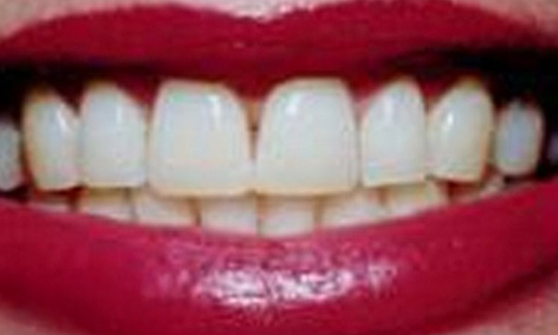 Close-up of a smiling mouth with white teeth and red lipstick, illustrating dental aesthetics relevant to smile makeovers at Dr. Palani's dental practice.