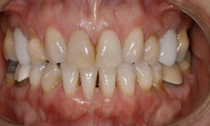 Close-up of teeth showing discoloration and alignment issues, relevant to smile makeover services at Dr. Palani's dental practice in Rancho Palos Verdes, CA.