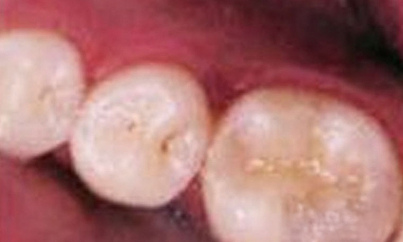 Close-up image of dental crowns on teeth, showcasing before and after results of a smile makeover procedure at Dr. Palani's dental practice in Rancho Palos Verdes, CA.