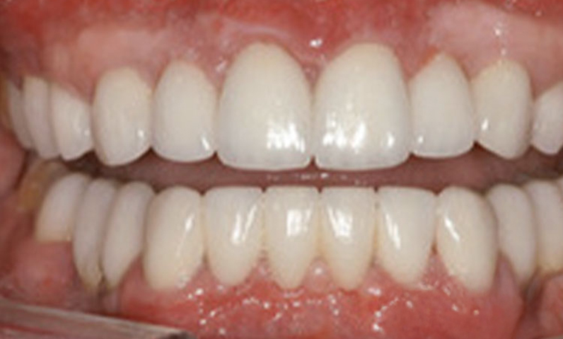 Close-up of a healthy smile showcasing well-aligned, bright white teeth, relevant to smile makeover services offered by Dr. Palani.