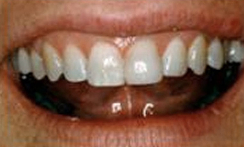 Close-up of a smiling mouth showcasing bright, white teeth, relevant to dental aesthetics and smile makeovers at Dr. Palani's dental practice.