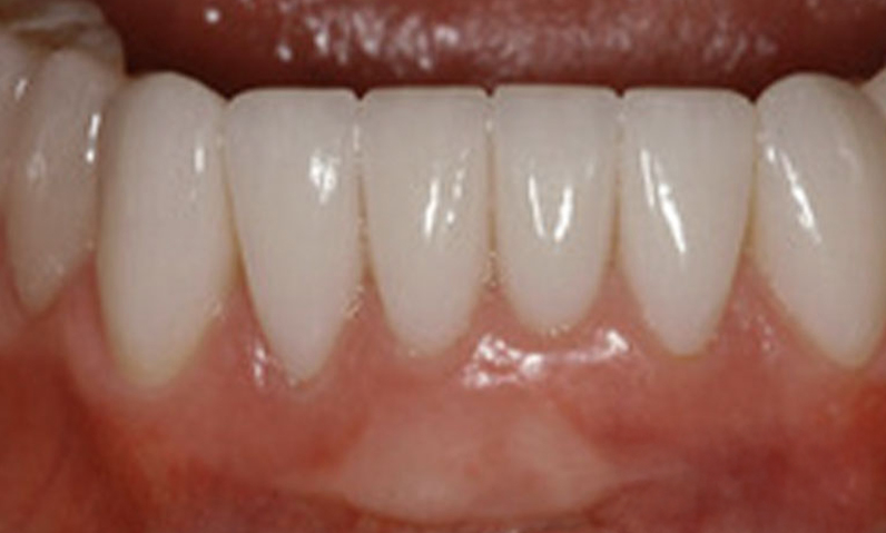 Close-up of a perfect smile showcasing bright, white teeth, relevant to dental treatments and smile makeovers at Dr. Palani's practice.