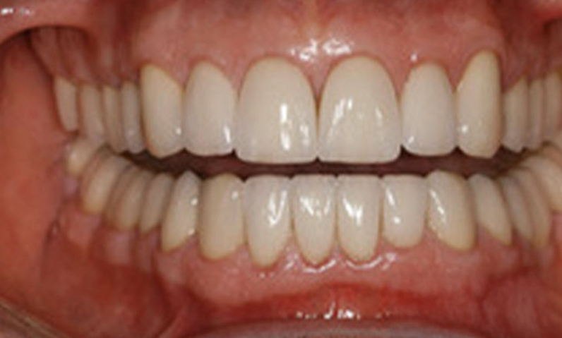 Close-up of a healthy smile showing straight, white teeth, highlighting dental aesthetics relevant to smile makeover services by Dr. Palani.