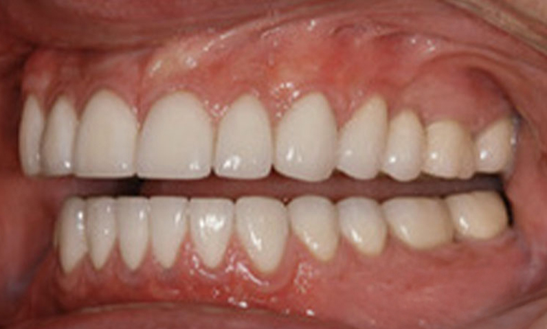 Before and after comparison of dental work showing improved smile aesthetics with aligned and whitened teeth, relevant to smile makeover services at Dr. Palani's dental practice.