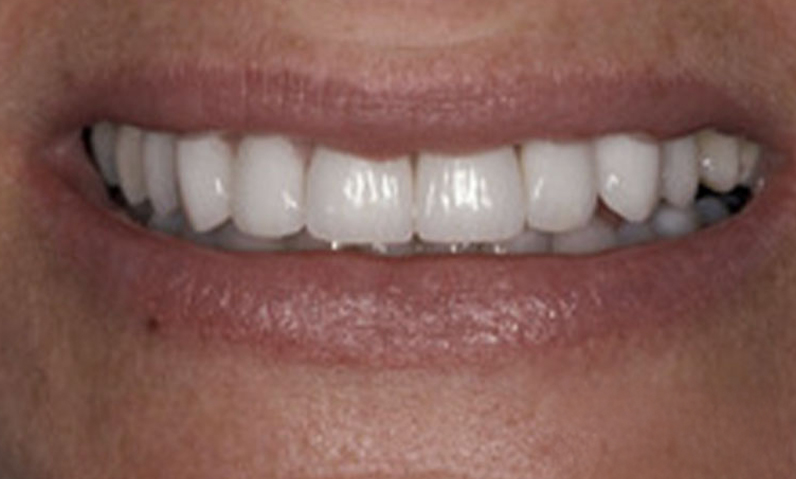 Close-up of a person's smile showcasing bright, white teeth, emphasizing dental aesthetics and smile makeover results related to services offered by Dr. Palani.