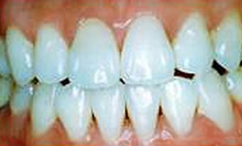 Close-up of a set of white teeth showcasing dental aesthetics, relevant to smile makeover services offered by Dr. Palani.