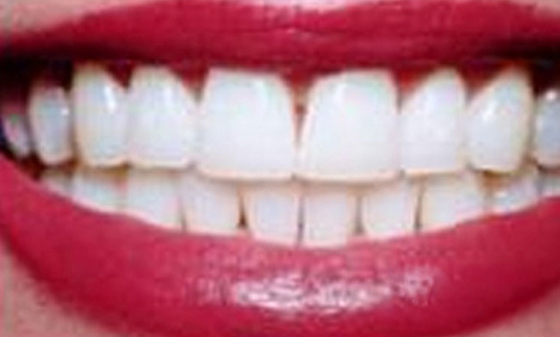Close-up of a bright, white smile with well-aligned teeth and red lipstick, showcasing dental aesthetics relevant to smile makeover services.