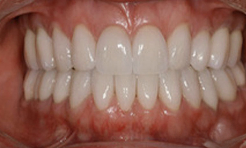 Close-up of a bright, straight smile showcasing dental aesthetics, relevant to smile makeovers offered by Dr. Palani in Rancho Palos Verdes, CA.