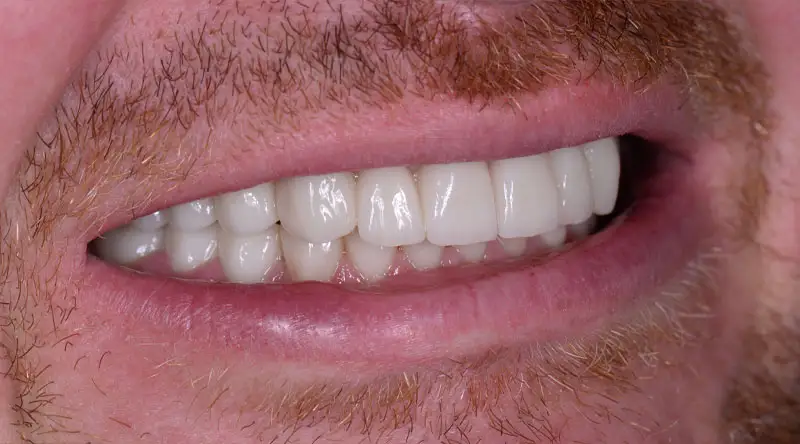 Close-up of a smiling mouth showcasing full mouth dental implants with bright, natural-looking teeth, highlighting the aesthetic results of the dental procedure at the Palani Center for Dental Implants.