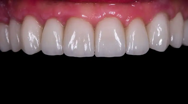 Dental implant results showcasing a full set of natural-looking teeth with healthy gums, illustrating the transformative effect of full mouth dental implants.