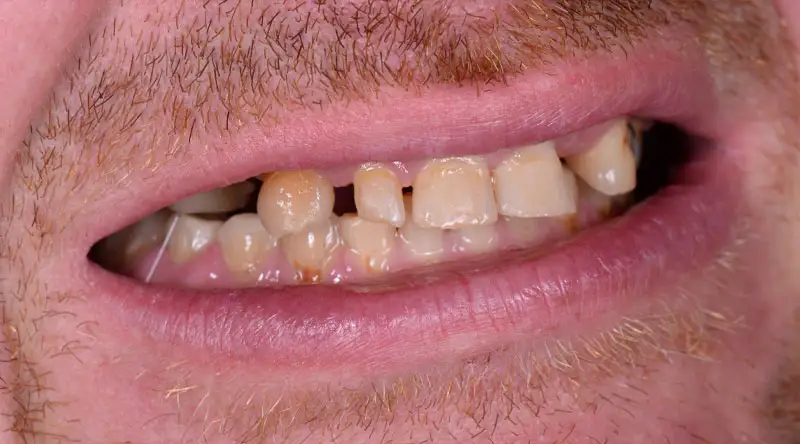 Close-up of a person's mouth showing missing and damaged teeth, illustrating the condition before a full mouth dental implant procedure at the Palani Center for Dental Implants.