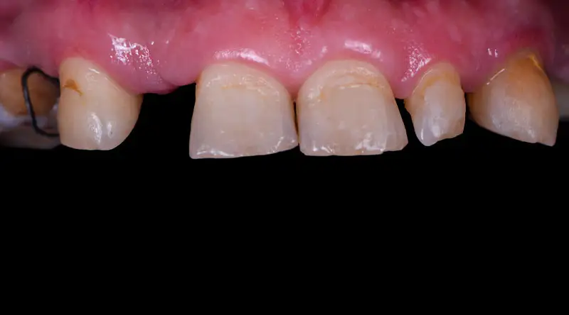 Dental implant site showing natural teeth and gum tissue, illustrating before treatment condition for full mouth dental implants at Palani Center for Dental Implants.