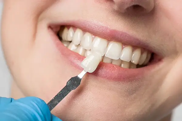 Person smiling with bright teeth while a dental professional holds a dental veneer in place, showcasing cosmetic dentistry for smile enhancement.